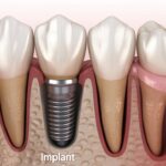 İmplant mı daha İyi Zirkonyum mu